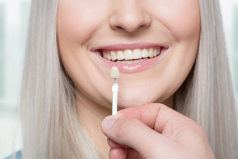 dental veneers patient smiling