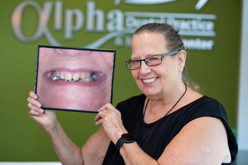 Sarah - dental implants patient