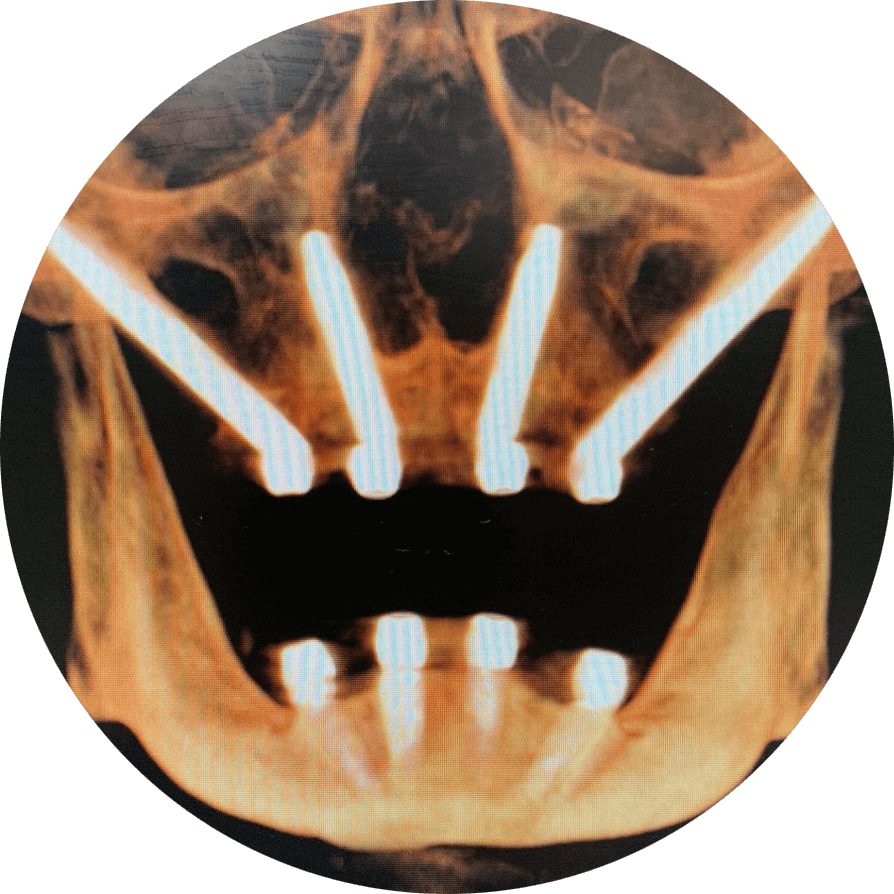 trans-nasal dental implants