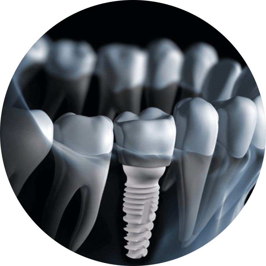 zirconia dental implants